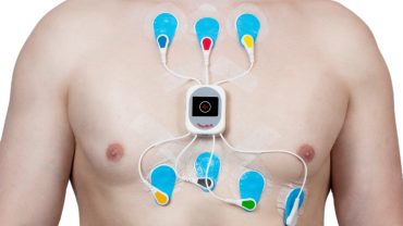 ELETTROCARDIOGRAMMA DINAMICO SECONDO HOLTER napoli