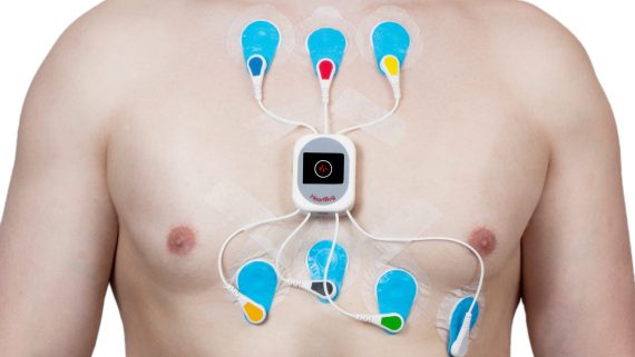 ELETTROCARDIOGRAMMA DINAMICO SECONDO HOLTER napoli